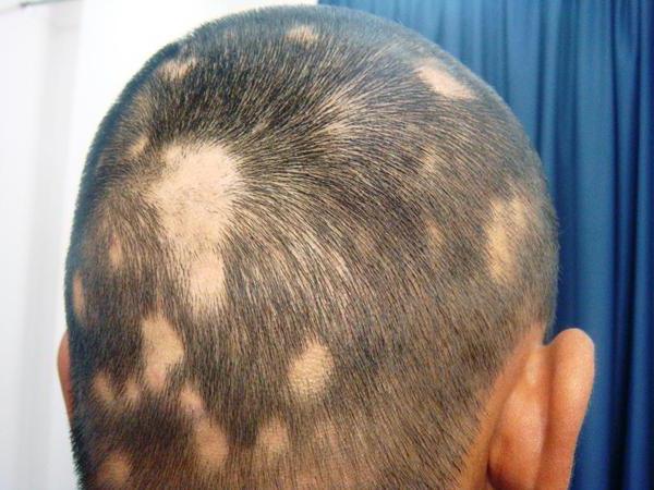 Alopecia u detí: príčiny a liečba. Ohnisková a celková alopécia u detí