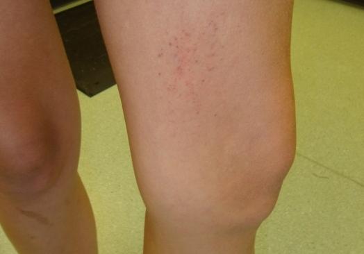 Plazenie vyrážky na nohách: príčiny, prevencia