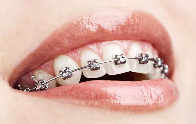 Ako umiestniť priečky v modernej stomatológii