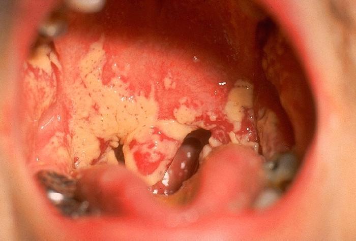 Kandidóza stomatitída: príčiny nástupu, symptomatológia a spôsoby eliminácie ochorenia