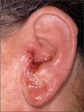 akútny otitis externa