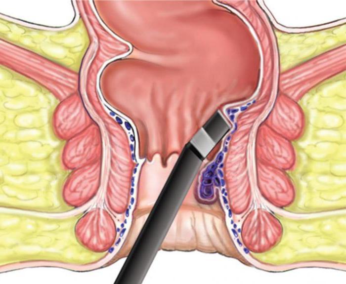 hemoroidy s laserom