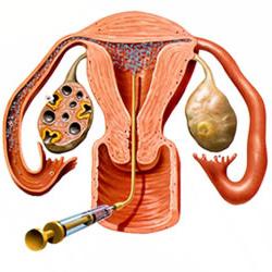 IVF s polycystickým vaječníkom