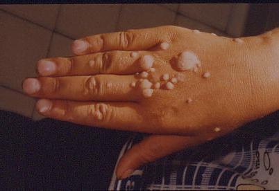 Infekcia papilomavírusu: základné informácie
