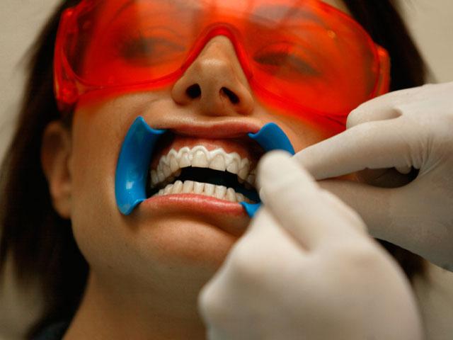 Postup bielenia zubov: recenzie a odporúčania