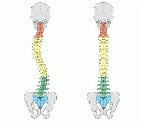 skolióza, čo to je