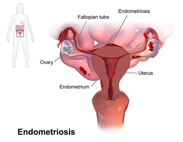 mirena pri endometrióze